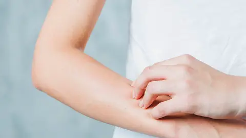 ¿Dermatitis atópica en verano?: Así es cómo puedes tratarla en casa. Foto freepik.