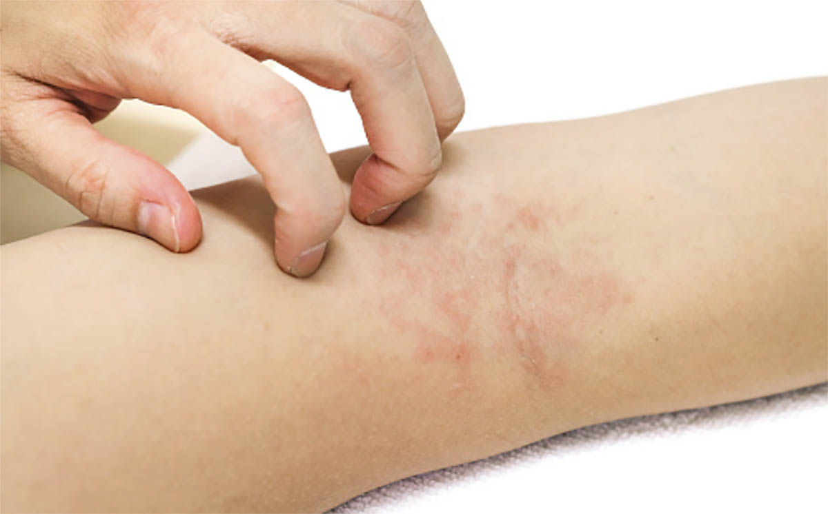 Dermatitis atópica en verano: dermatitis