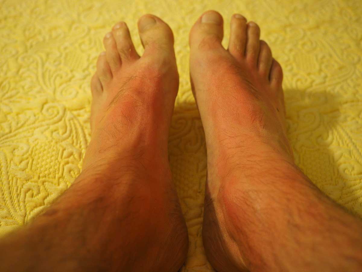 Alergia al sol
